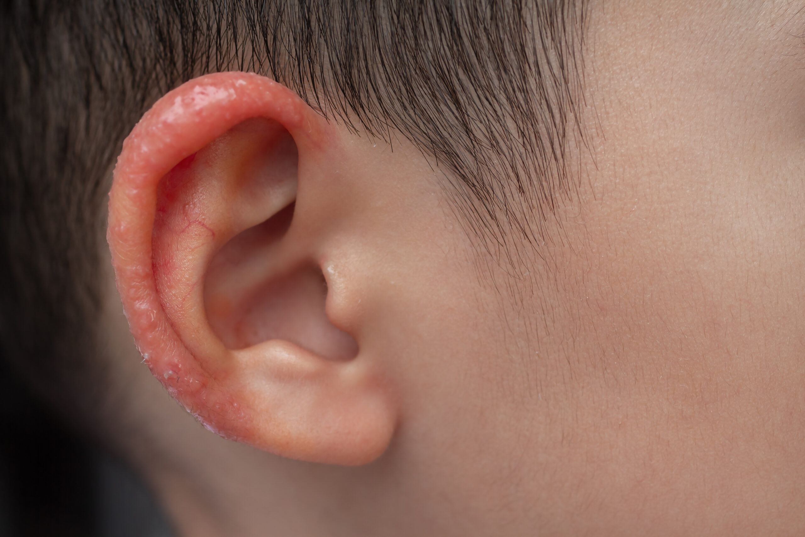 赤ちゃんの耳のジュクジュクは乳児湿疹？原因と自宅での対策は？