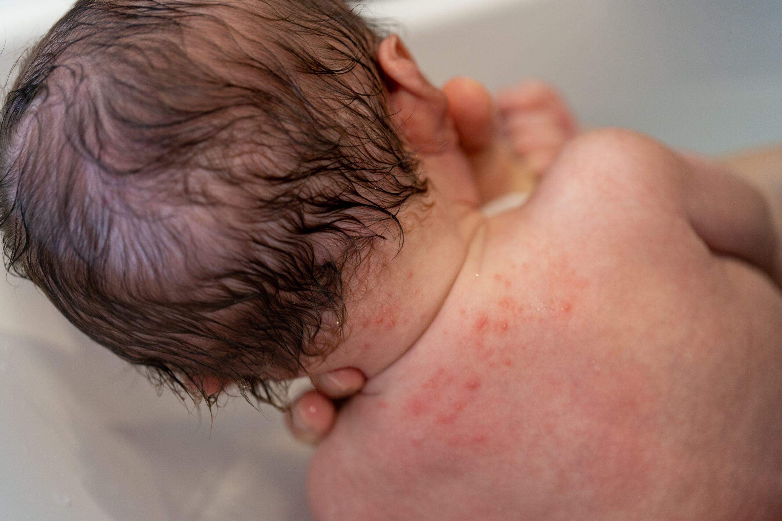 【写真で解説】赤ちゃんの首にできる乳児湿疹の症状・原因・ケア方法