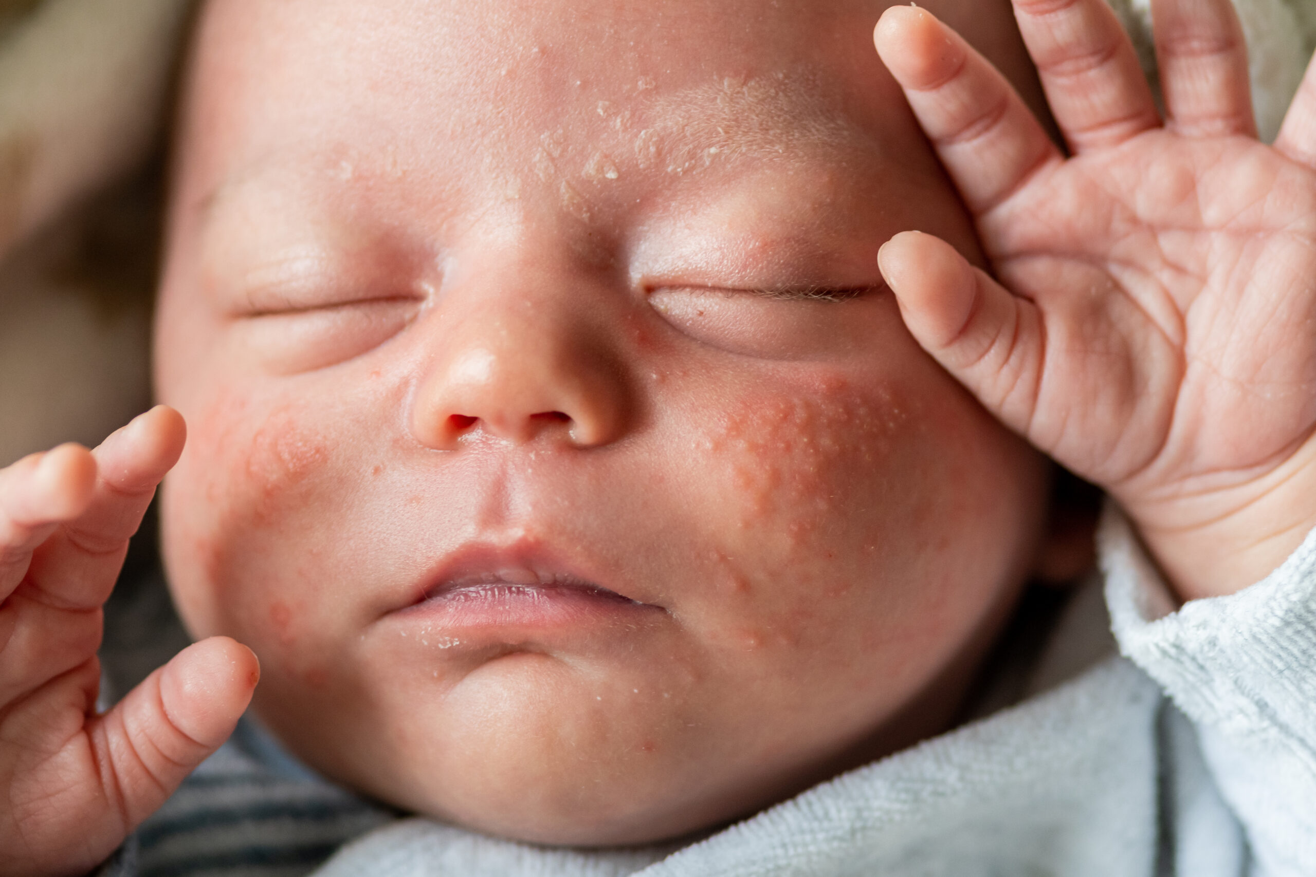 乳児湿疹とアトピー性皮膚炎の違い。見分け方や対策は？