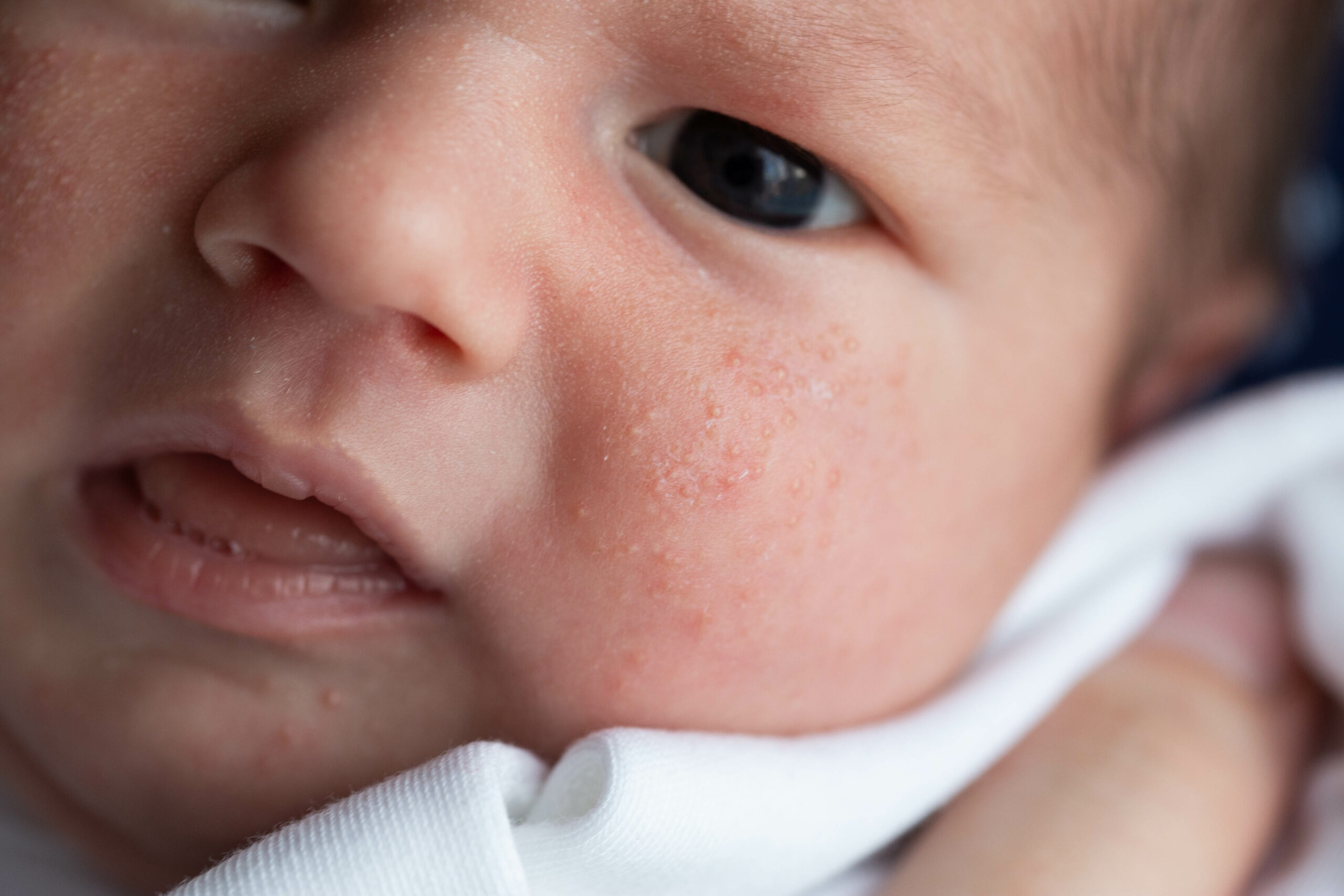 赤ちゃんの顔にできるブツブツ。これって乳児湿疹？