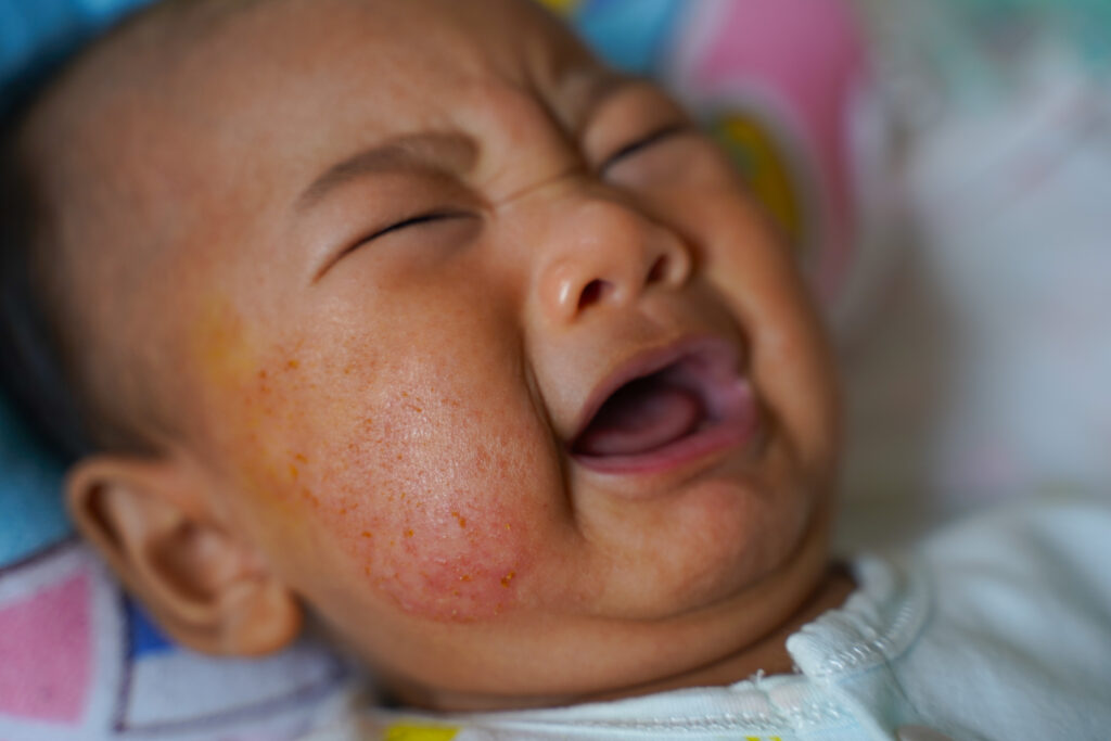 脂漏性湿疹の赤ちゃん